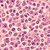 Lymphoma cells