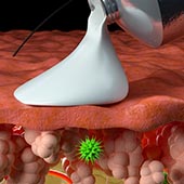 Synthetic melanin being applied to inflamed skin