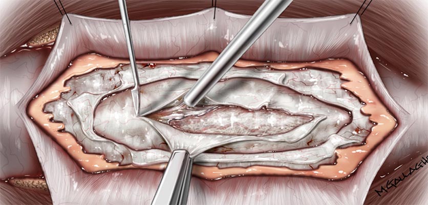 A schematic image of a surgical procedure